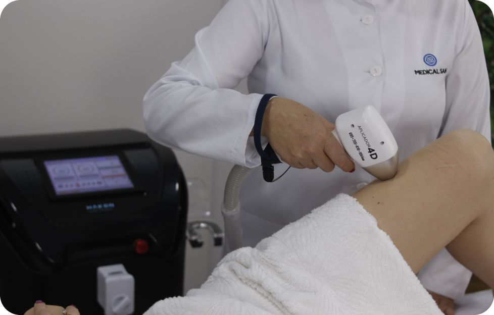 Aplicação do Hakon, laser 4D para epilação